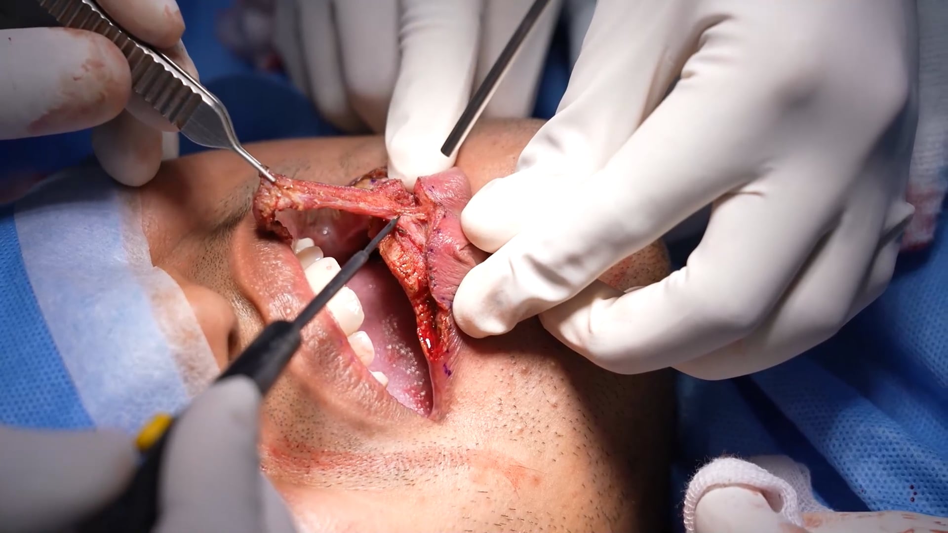 Lip Reduction Surgery